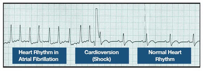 Cardioversion